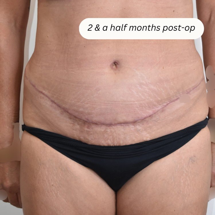 Abdominoplasty (Tummy Tuck) - Queensland Plastic Surgery